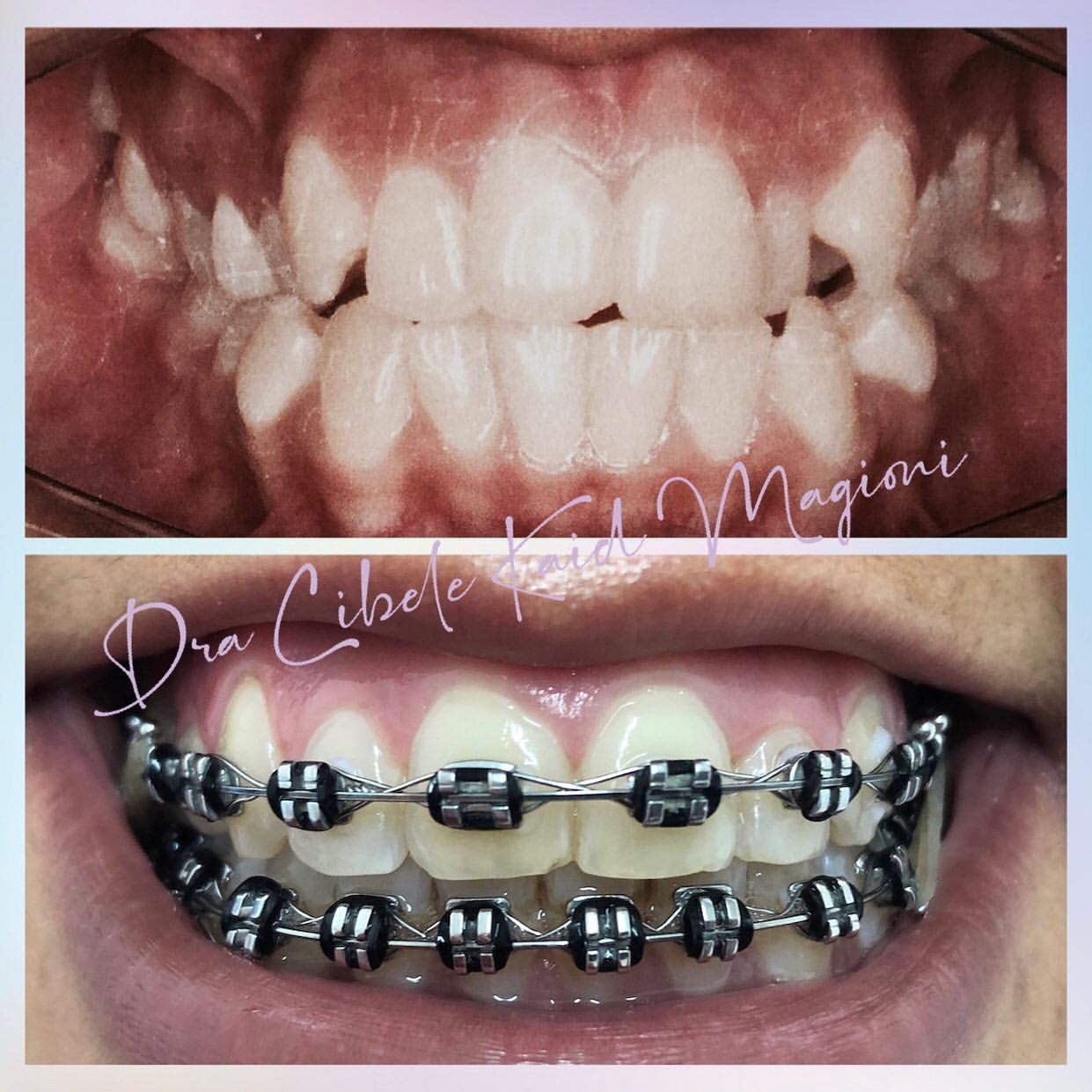Sorriso Alinhado com Invisalign (antes e depois)